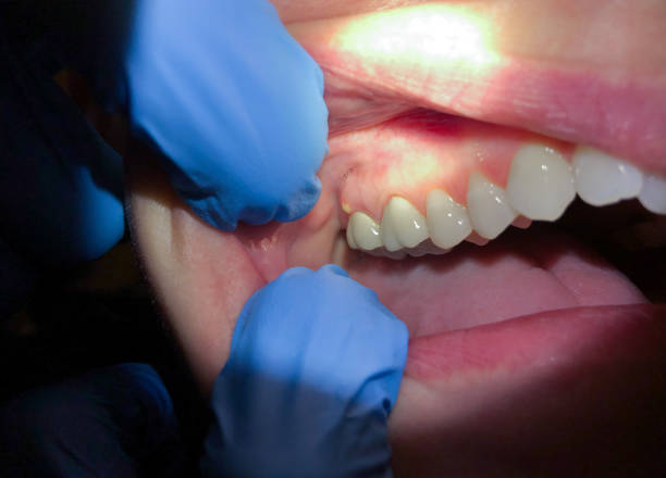 Best Emergency Wisdom Tooth Extraction in Pine Grove, PA